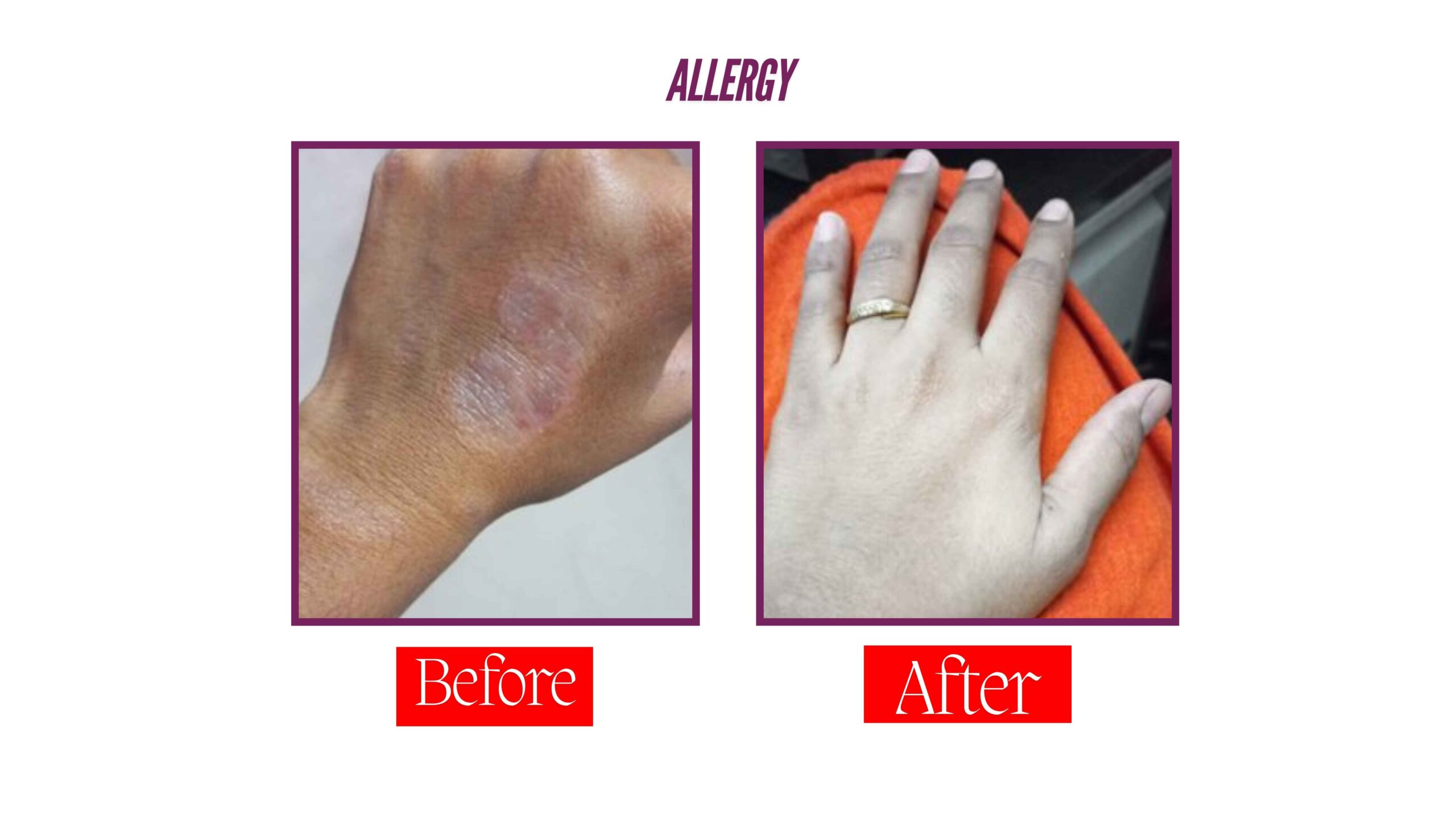 Allergy Compressed