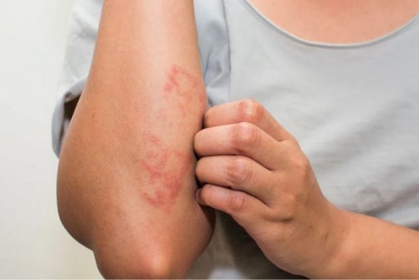 Skin Infection
