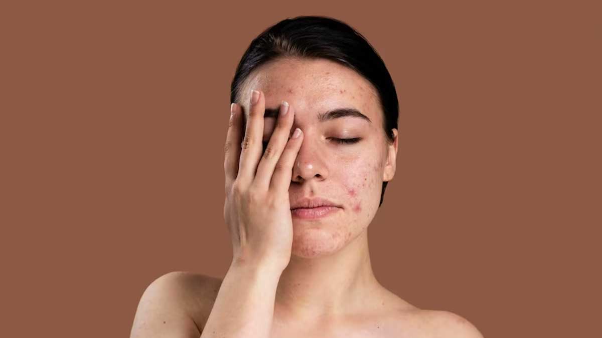 Pimples